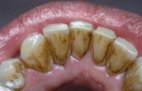 Как удалить налет на зубах?